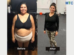 A Healthier You – Benefits of Bariatric Surgery in Turkey